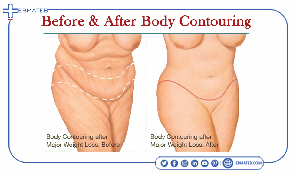 before and after body contouring